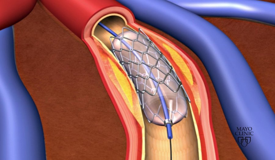 heart-stenting