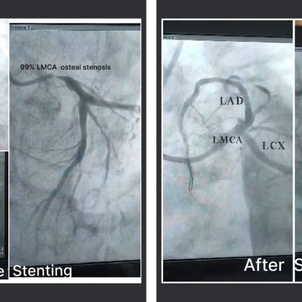 high-risk-lmca-stenting